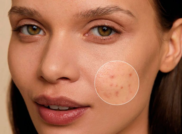 Почему кожа постоянно воспаляется, даже если вы ухаживаете за ней правильно